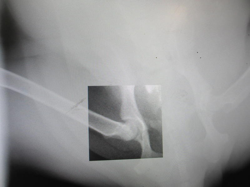 беременная подмашинница с переломами • Срочники!