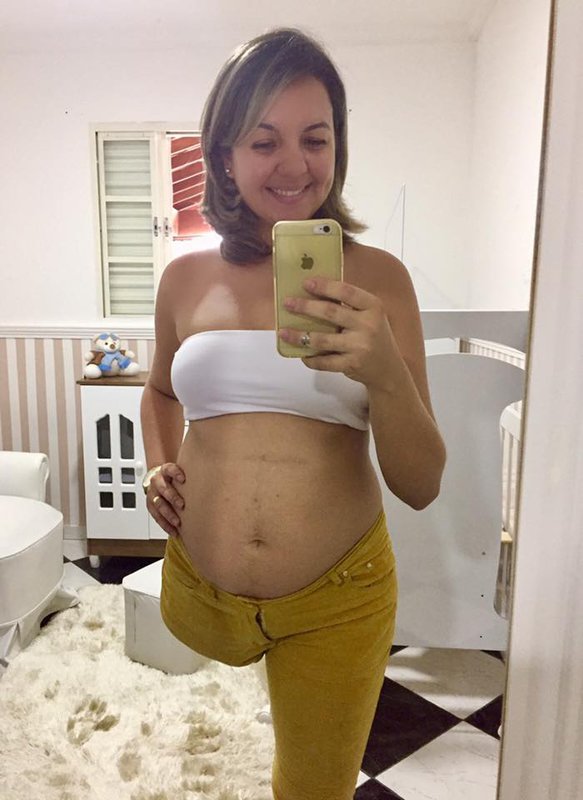 Amputee Pregnant