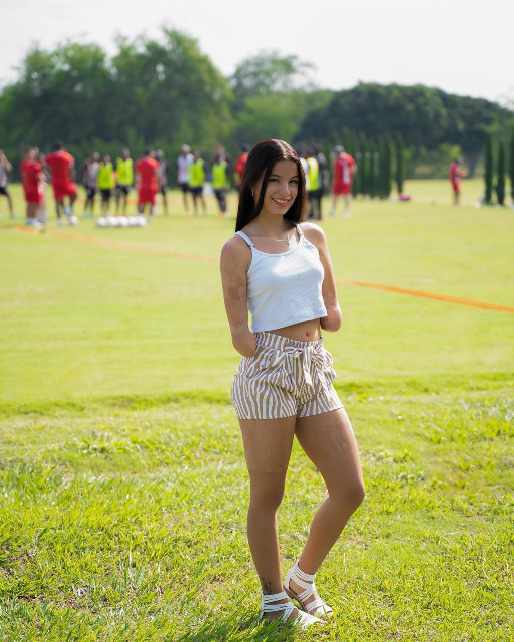 Arm amputee ladies - Дамы с ампутированной рукой