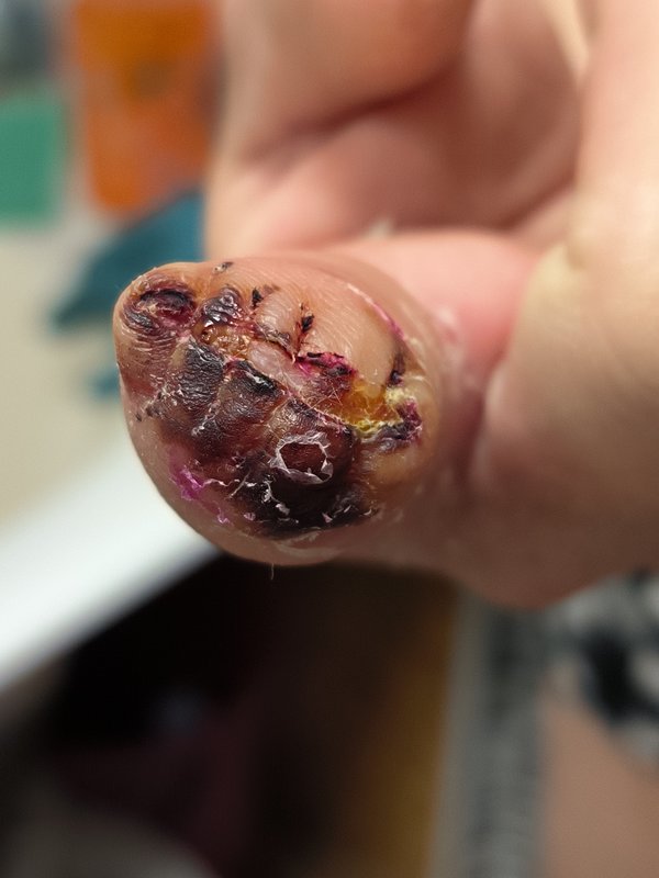 Добровольная ампутация.